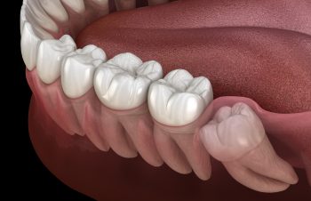 Wisdom Tooth Removal