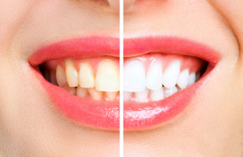 Tooth Whitening