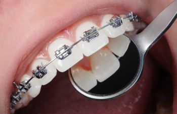 Orthodontic Treatment