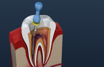 Single Sitting Root Canal Treatment