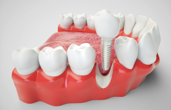 Dental Implants